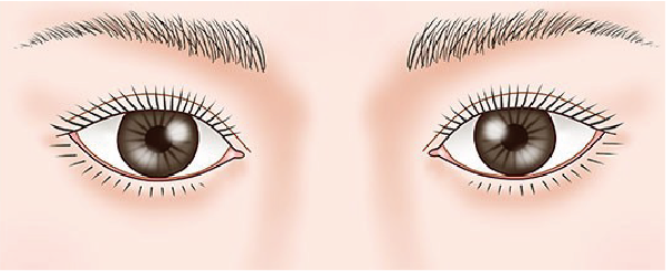 蒙古襞修正 ビフォーアフター